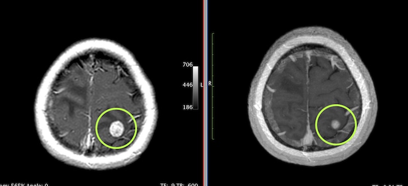 {Brain Metastasis MRI before and 1 month after Rotating Gamma System Radiosurgery.}
